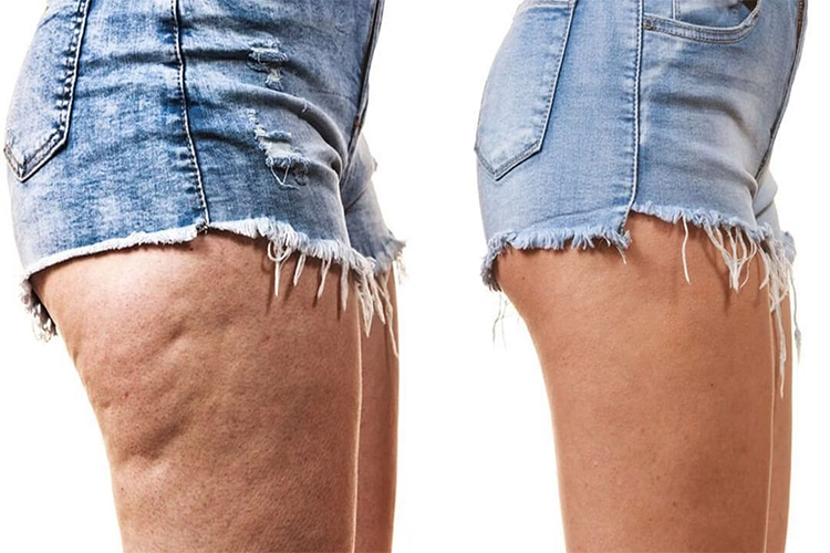 7 EXERCISES TO GET RID OF CELLULITE ON THIGHS AND BUTT