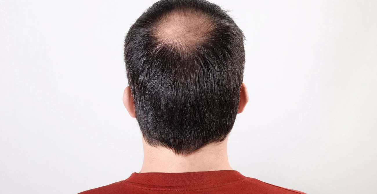Men's hair loss solutions that work.